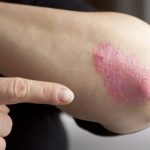 Sa fii atins de psoriazis nu inseamna sa nu mai poti fi atins!