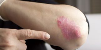 Sa fii atins de psoriazis nu inseamna sa nu mai poti fi atins!